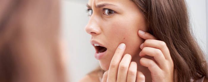 Intense Light Acne Treatment in Plymouth