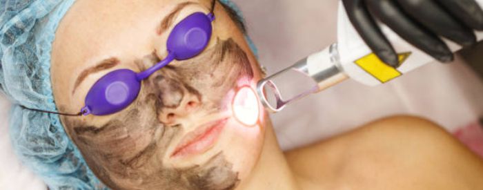 Laser Carbon Skin Rejuventation in Plymouth