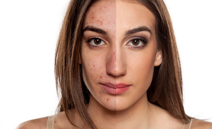 IPL Intense Pulsed Light Acne Treatment in Plymouth