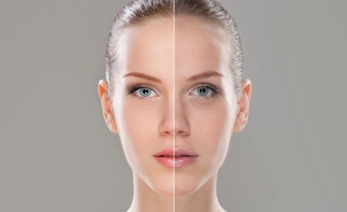 Laser Pigmentation Reduction in Plymouth