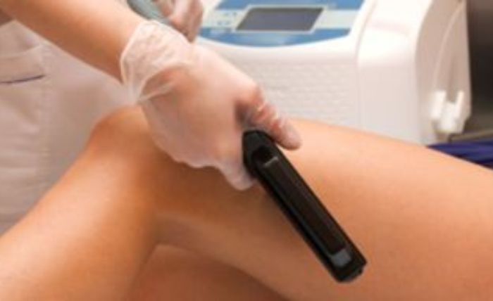 Red Vein Removal Treatment in Plymouth