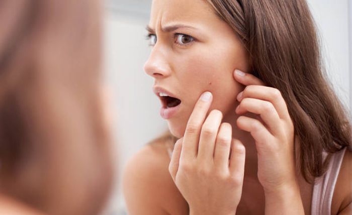 Intense Pulsed Light Acne Treatment in Plymouth
