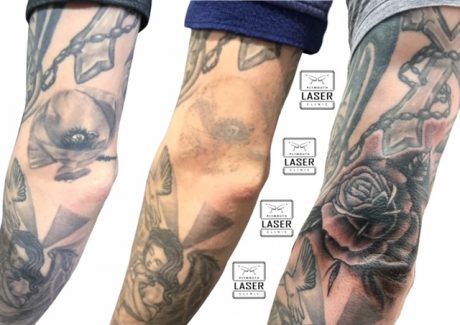 Tattoo Removal