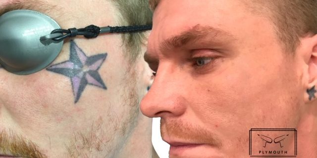 Face Tattoo Removal