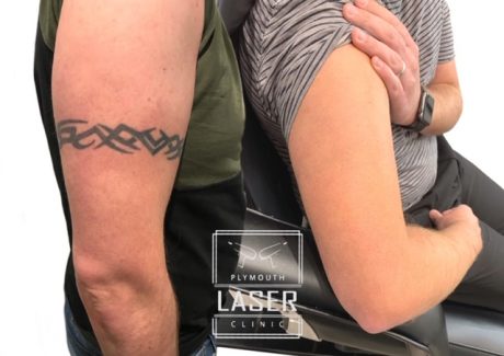 Tattoo Removal