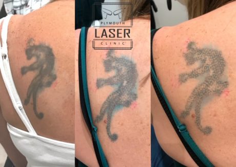 Tattoo Removal