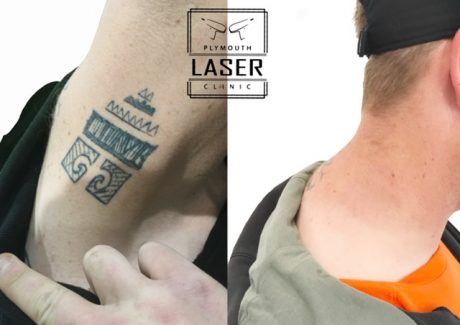 Tattoo Removal