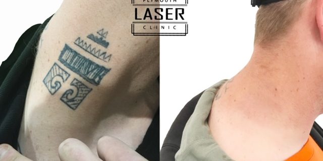 Tattoo Removal