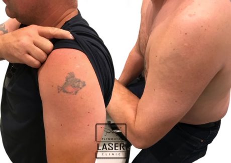 Tattoo Removal