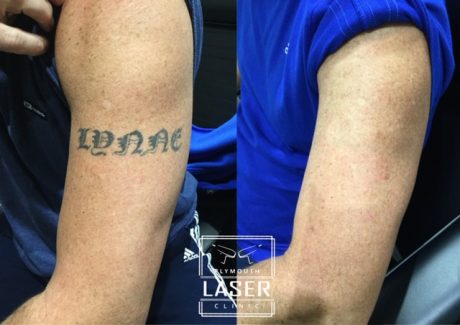 Laser Tattoo Removal
