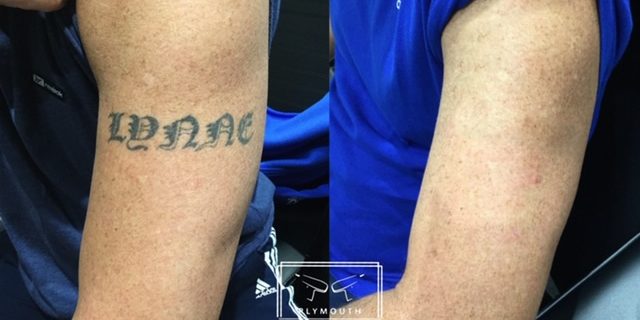 Laser Tattoo Removal