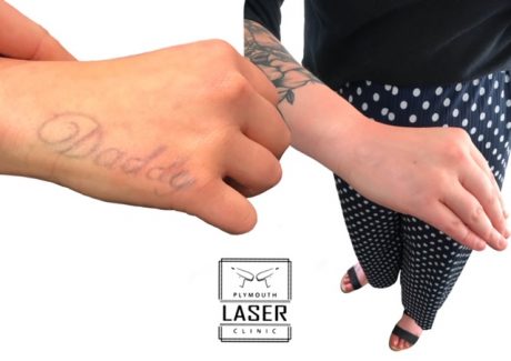 Tattoo Removal