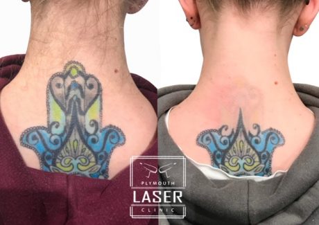 Laser Tattoo Removal