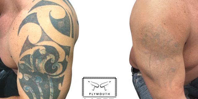 Laser Tattoo Removal