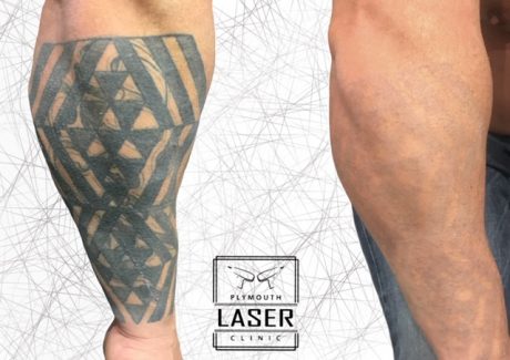 Forearm Tattoo Removal