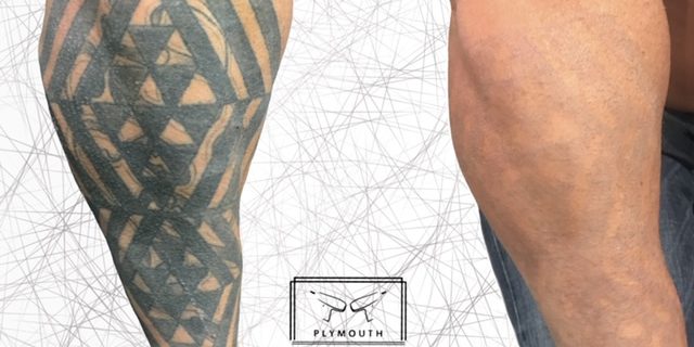 Forearm Tattoo Removal