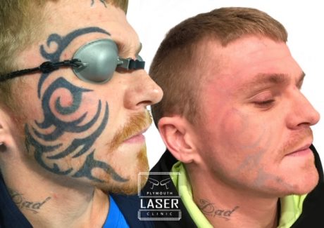 Face Tattoo Removal