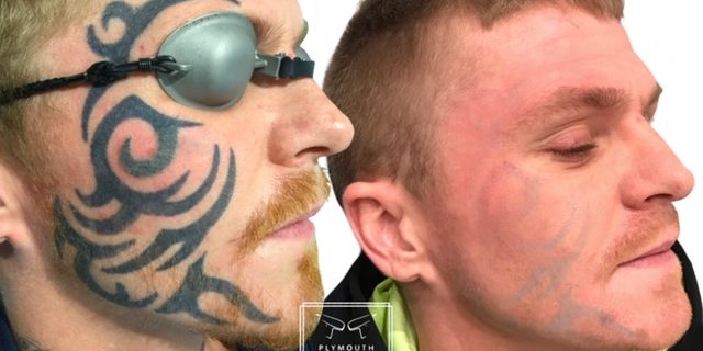 Face Tattoo Removal
