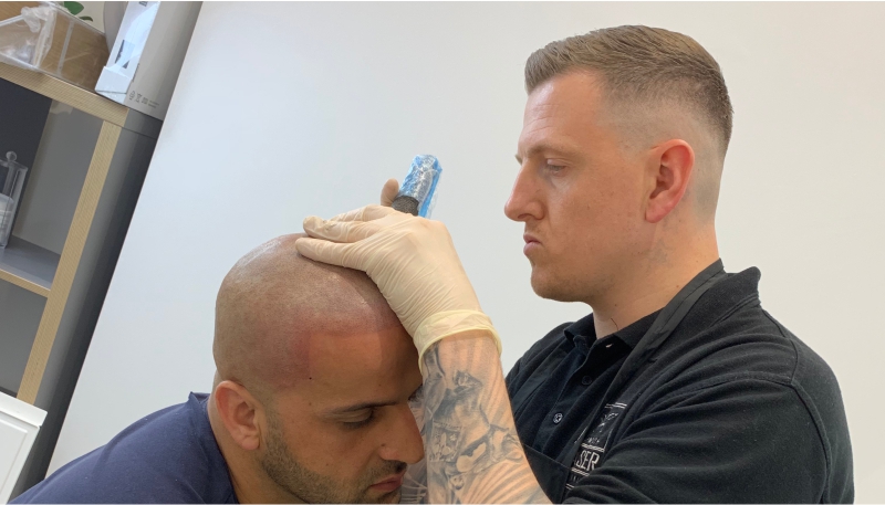 Devon Scalp Micropigmentation SMP