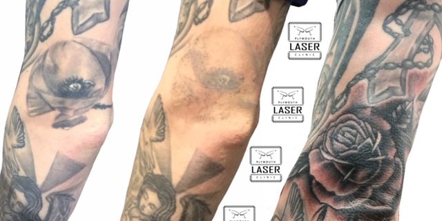 Tattoo Removal