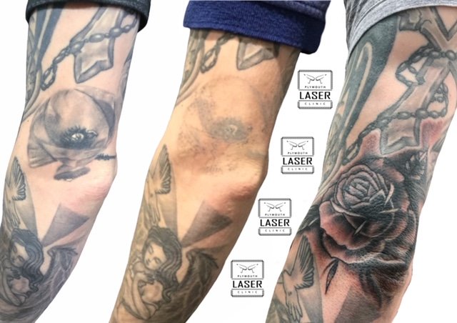 Tattoo Removal