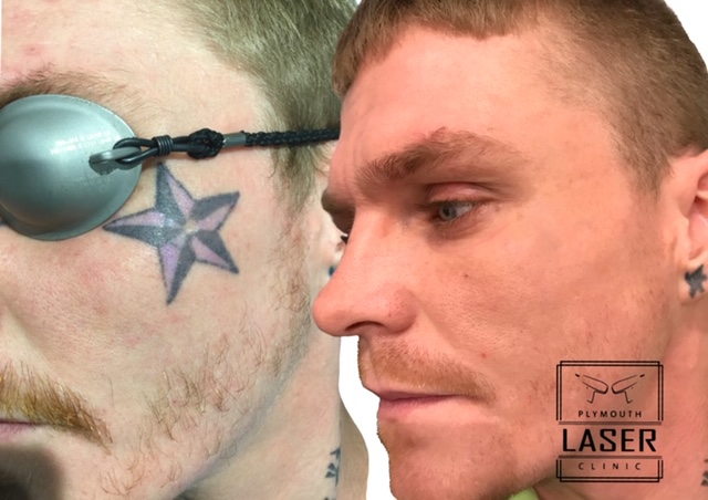 Face Tattoo Removal