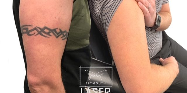 Tattoo Removal