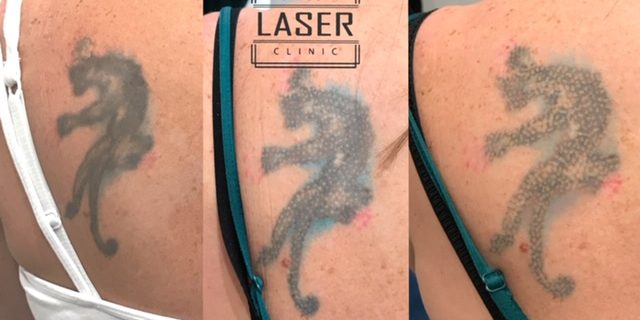 Tattoo Removal