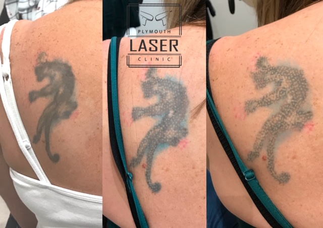 Tattoo Removal