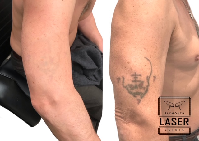 Tattoo Removal