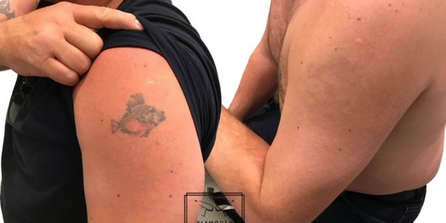 Tattoo Removal