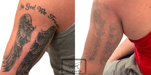 Tattoo Removal