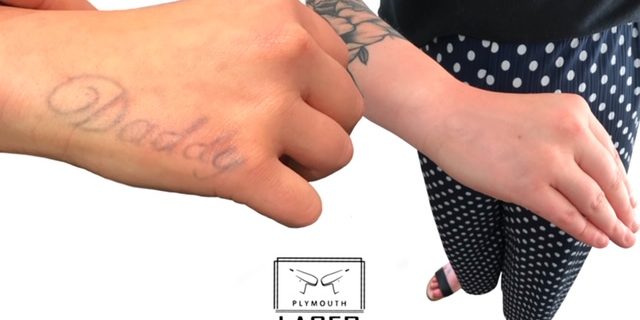 Tattoo Removal