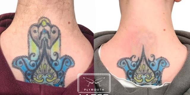 Laser Tattoo Removal