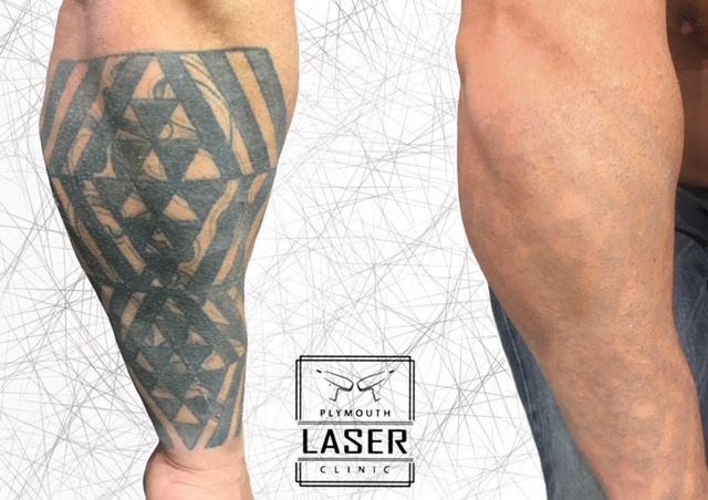 Forearm Tattoo Removal