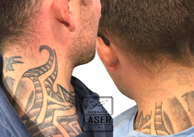 Neck Tattoo Removal