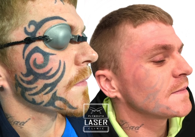 Face Tattoo Removal