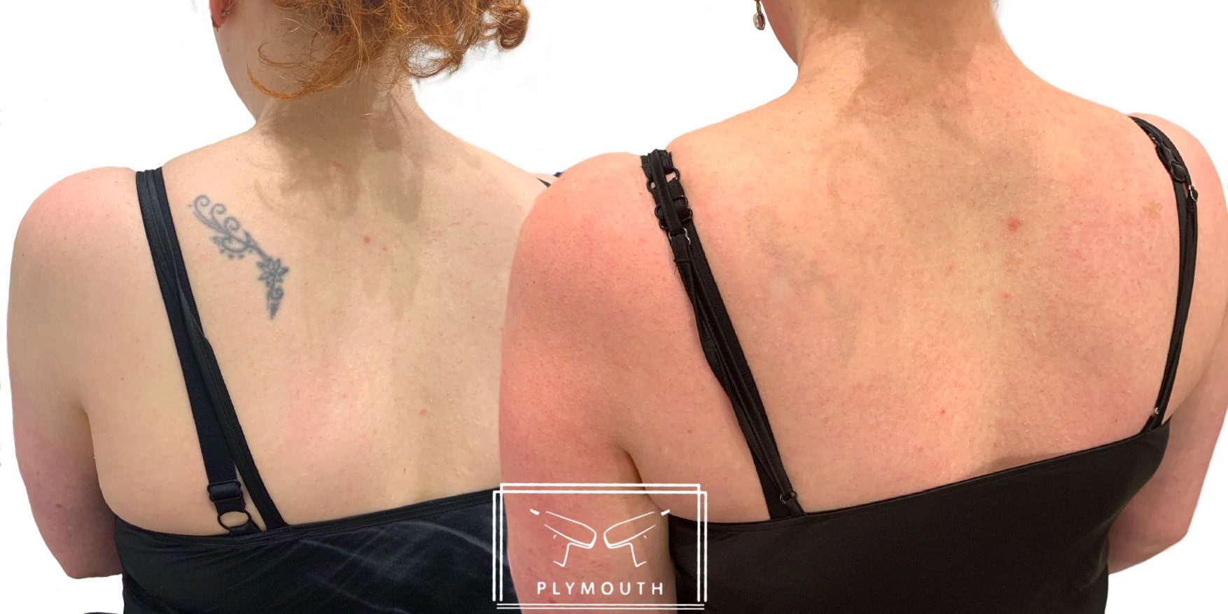 Laser Tattoo Removal in Devon