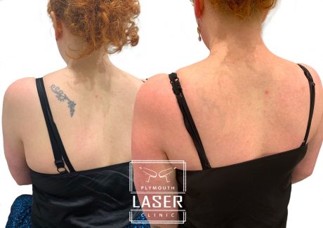 Laser Tattoo Removal in Devon