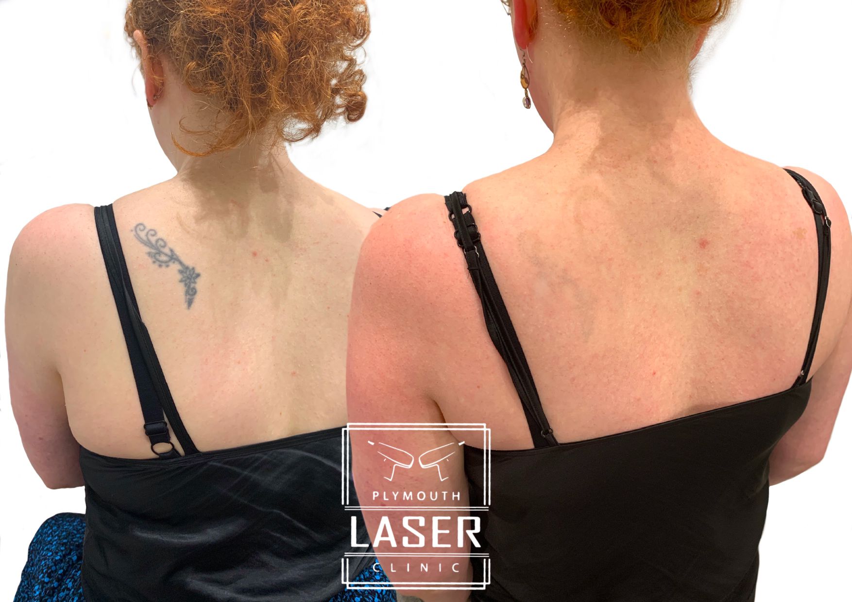 Laser Tattoo Removal in Devon