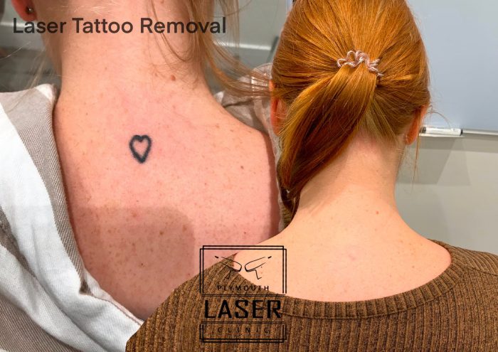 Laser Tattoo Removal in Plymouth